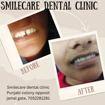 Teeth whitening